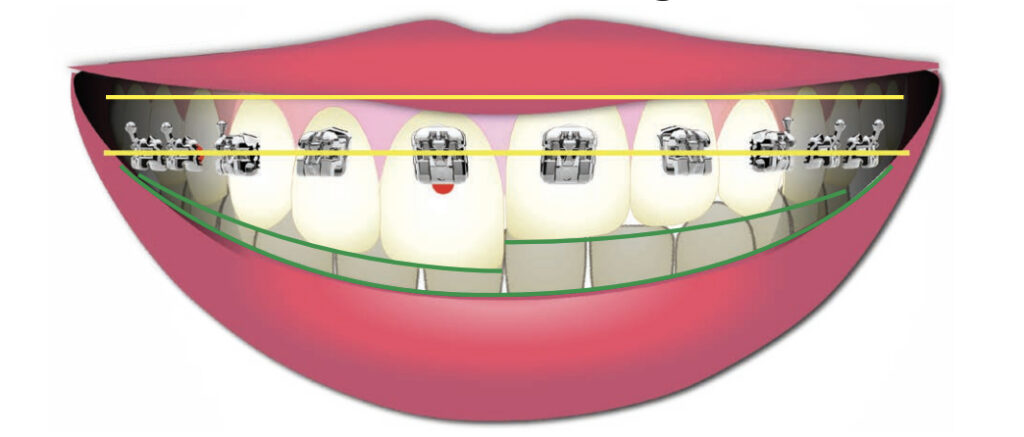 Braces South Ogden UT