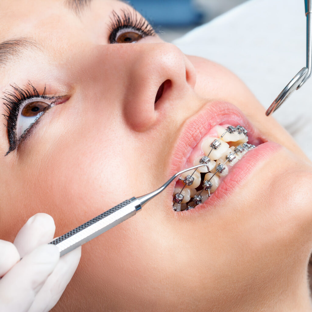 How Does the Braces Removal Process Work?