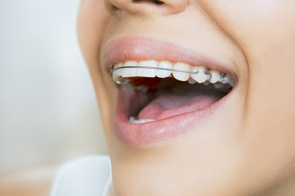 Beautiful smiling girl with retainer for teeth. Retainer After Braces